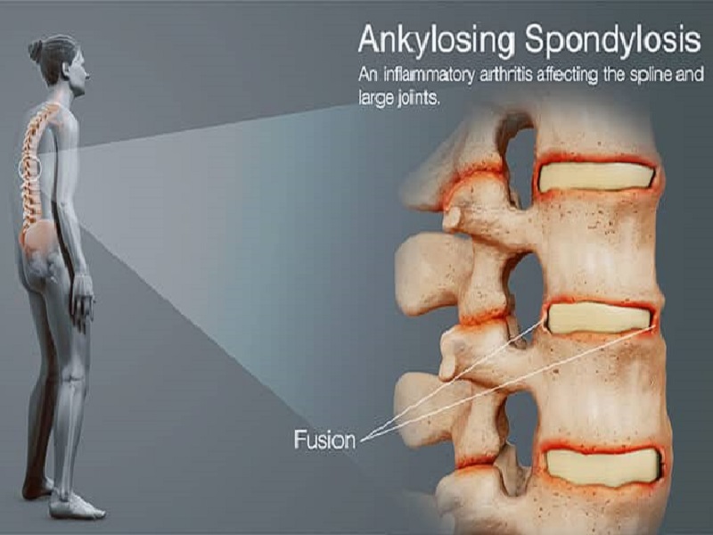 Ankylosing Spondylitis Treatment