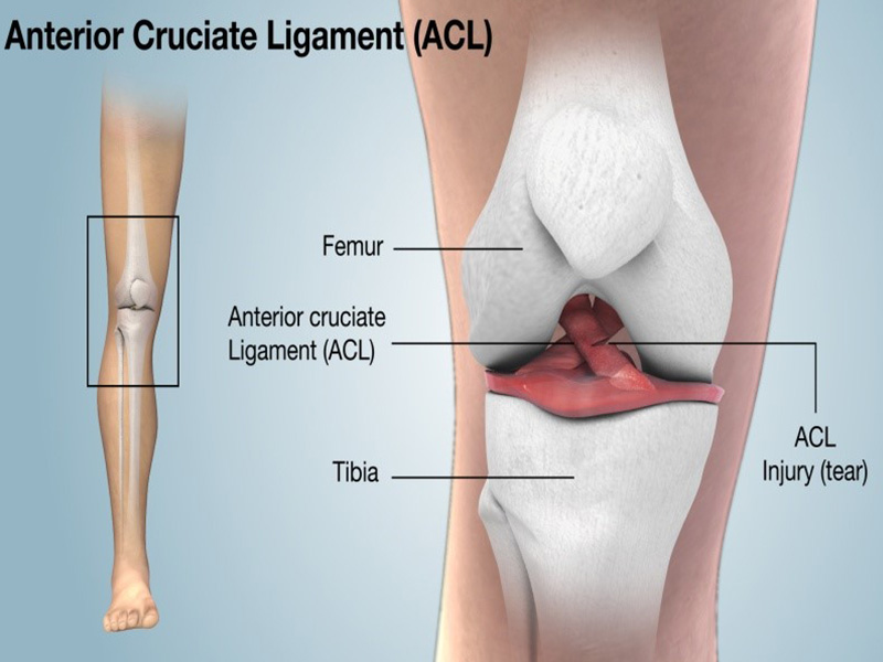 Anterior Cruciate Ligament Injury