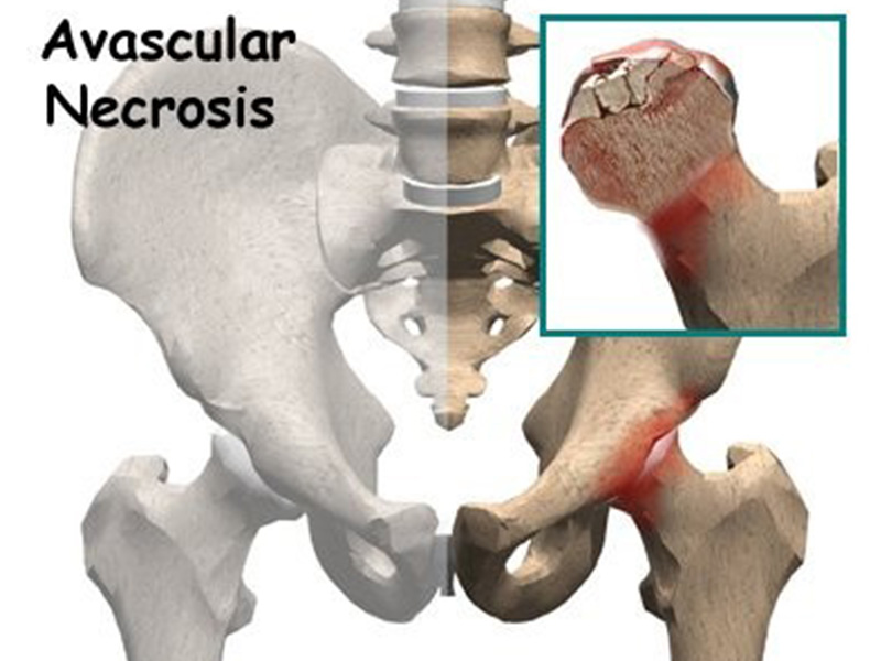 Avascular Necrosis of Femur Treatment