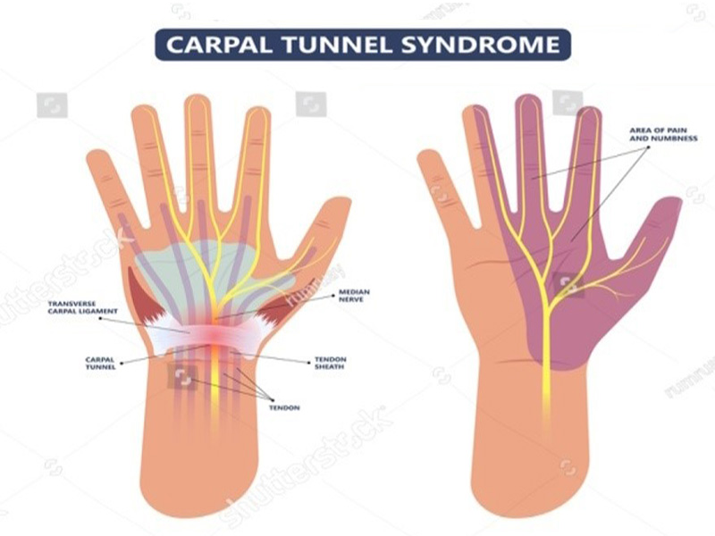 Carpal Tunnel Syndrome