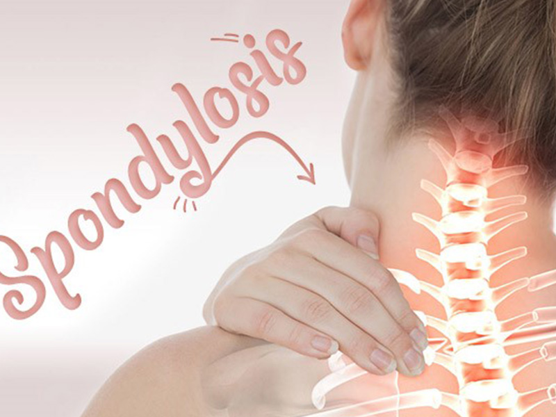 Cervical Spondylitis Treatment