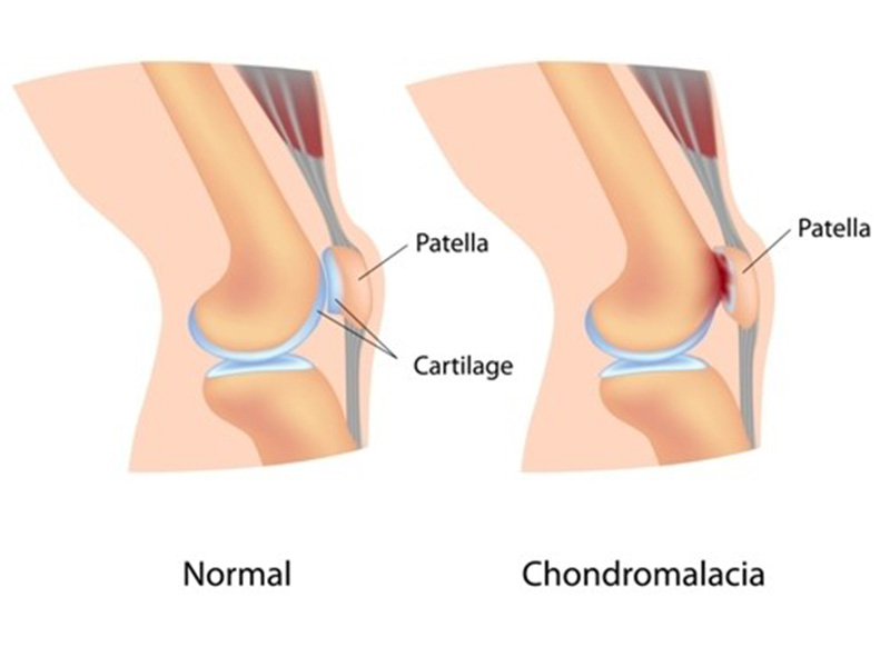 Chondromalacia Patella