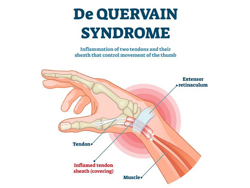 Dequervains Synovitis Syndrome