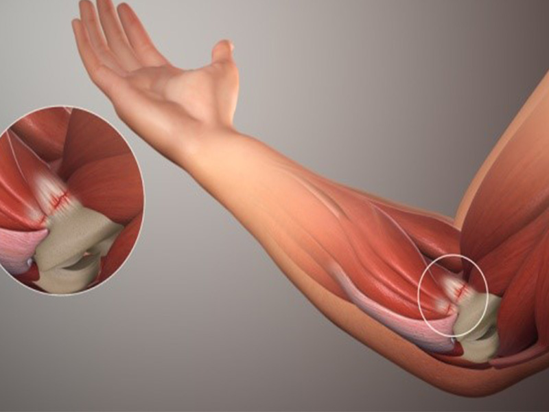 Golfers Elbow Treatment