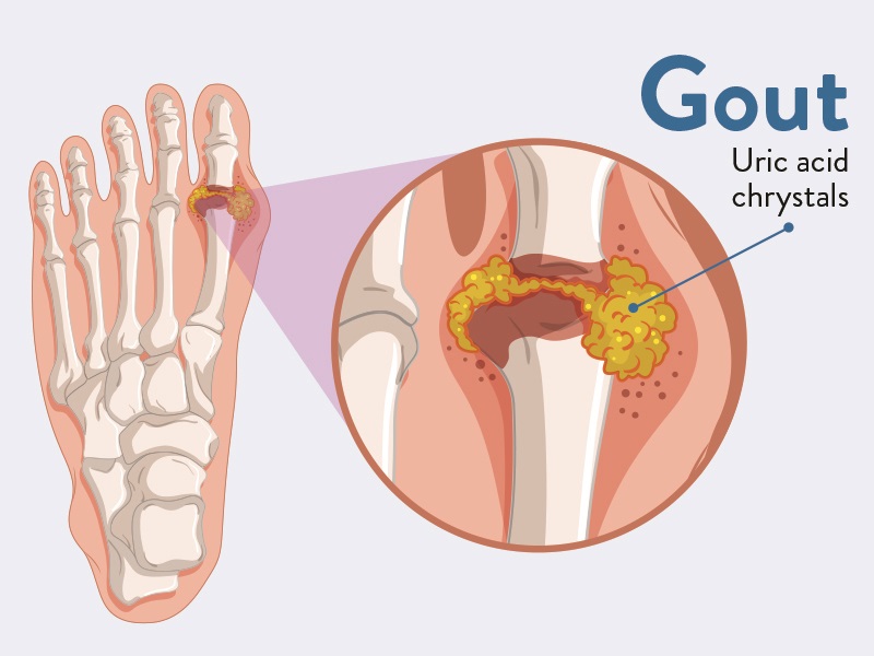 Gout Treatment