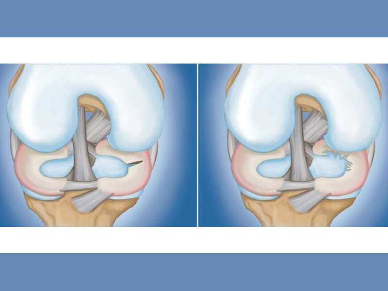 Meniscus Tear Treatment