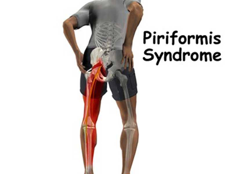 Piriformis Syndrome Treatment