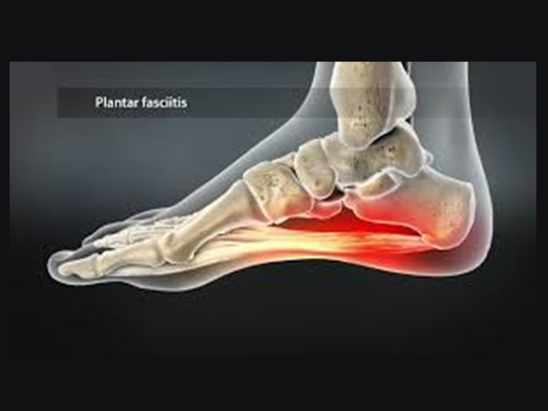 Plantar Fascitis Treatment