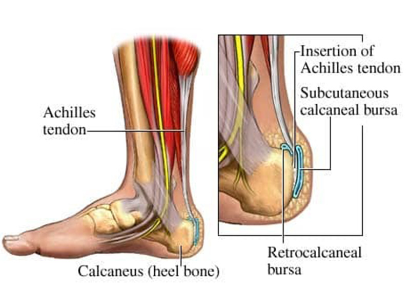 Retrocalcaneal Bursitis