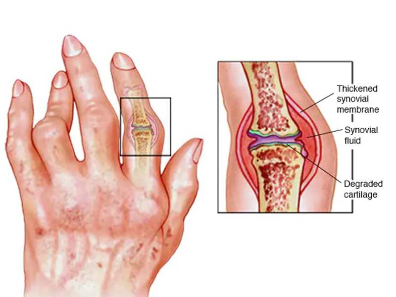 Rheumatoid Arthritis Treatment