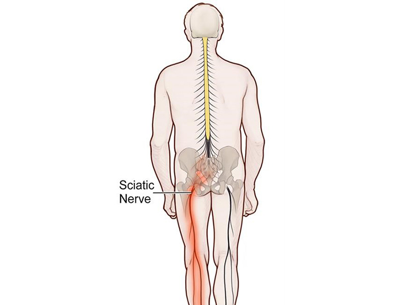 Sciatica Treatment