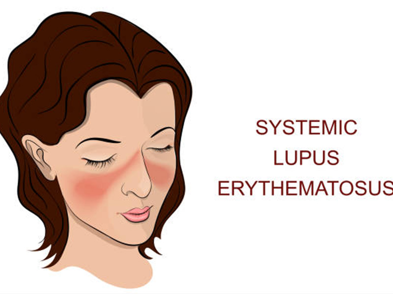 Systemic Lupus Erythematosus Treatment