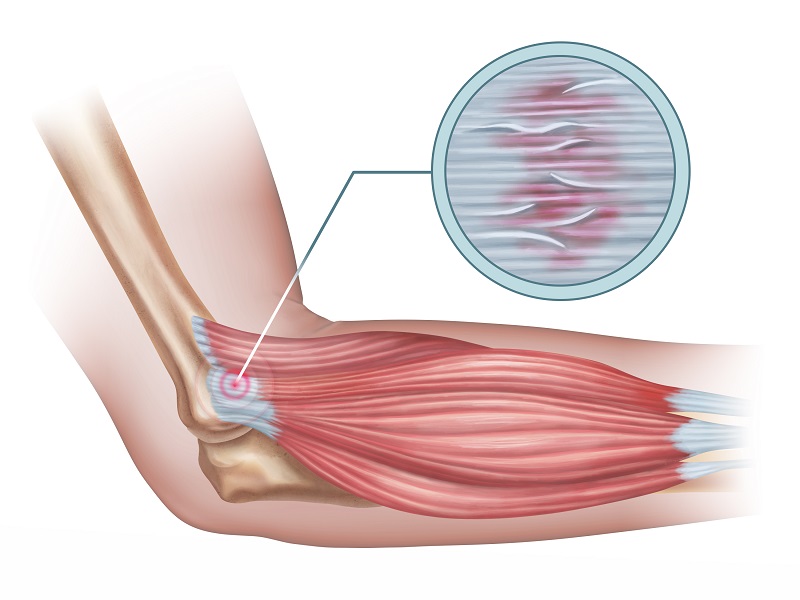 Tennis Elbow Treatment