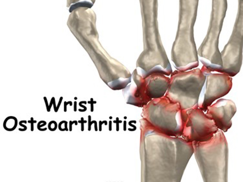 Wrist Joint Osteoarthritis