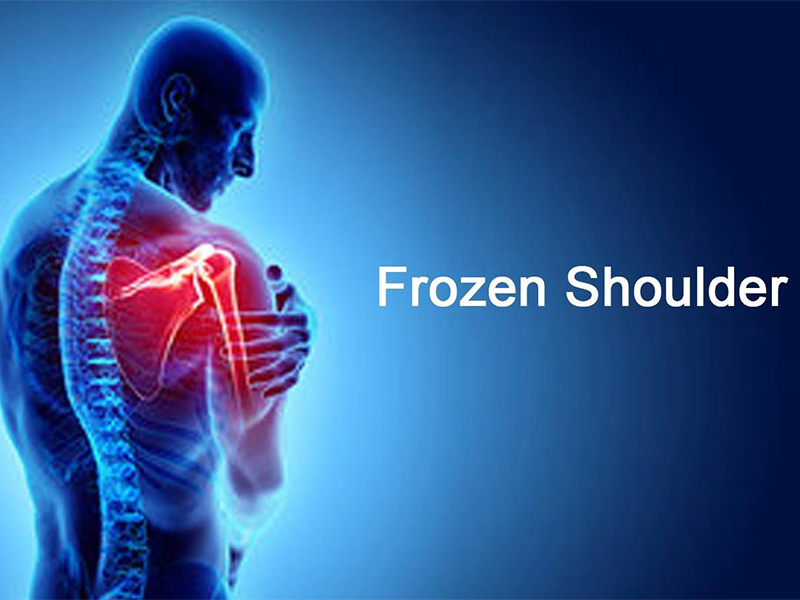 Frozen Shoulder